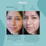 سرم ضدلک شفاف کننده و از بین برنده جای جوش دارک اسپات مناسب انواع پوست اکسیس وای 50 میل - Image 9