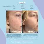 سرم ضدلک شفاف کننده و از بین برنده جای جوش دارک اسپات مناسب انواع پوست اکسیس وای 50 میل - Image 11