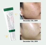 سرم ضدلک شفاف کننده و از بین برنده جای جوش دارک اسپات مناسب انواع پوست اکسیس وای 50 میل - Image 4